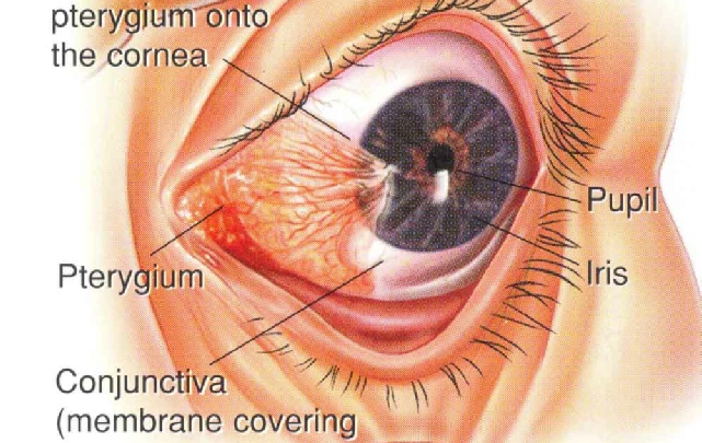 Pterygium Is Eye