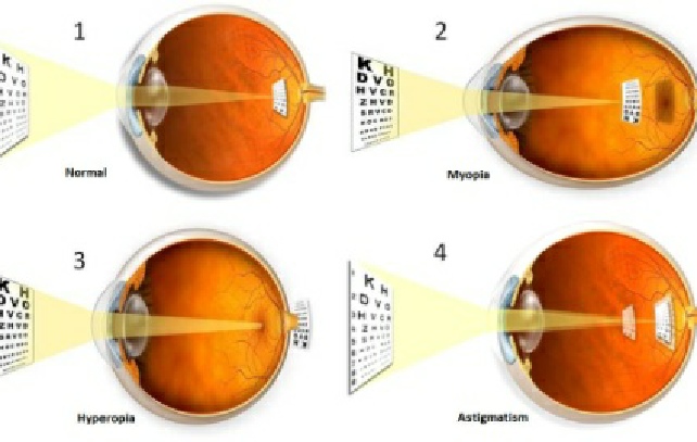 нарушение рефракции глаза